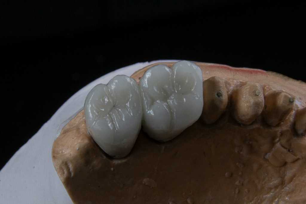 Показания и противопоказания к имплантации 2-х зубов